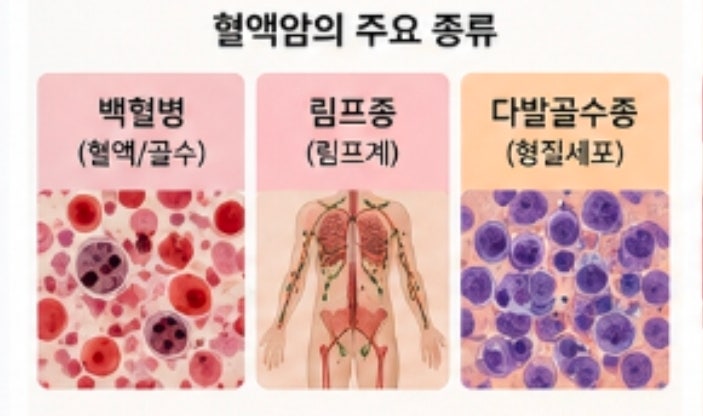 골수암 증상부터 혈액암 종류까지, 다발골수종을 제대로 이해하는 방법