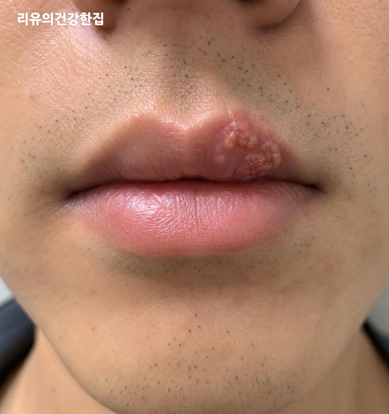 남자 여자 헤르페스 증상, 입술헤르페스 전염 원인, 성병일까?