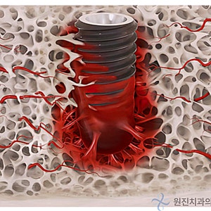 오스템 임플란트 등급별 차이는? SA CA BA SOI 비교