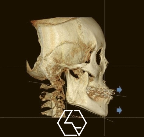돌출입 주걱턱 양악수술 입은 넣고 중안모 볼륨은 살리는 수술 계획