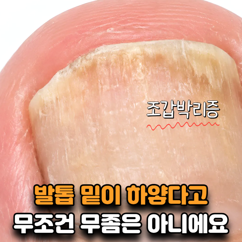 “무좀인 줄 알고 약부터 발랐어요” 그런데 발톱 밑이 계속 하얗게 비어요