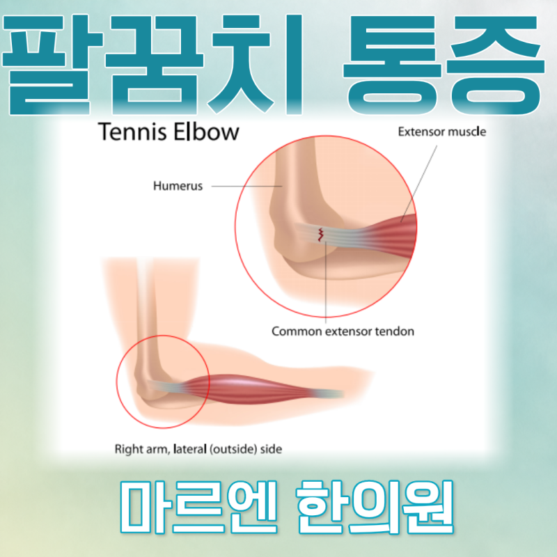 소염제를 먹어도 팔꿈치가 그대로인 이유 : 염증이 아니라 힘줄이 바뀌고 있었습니다