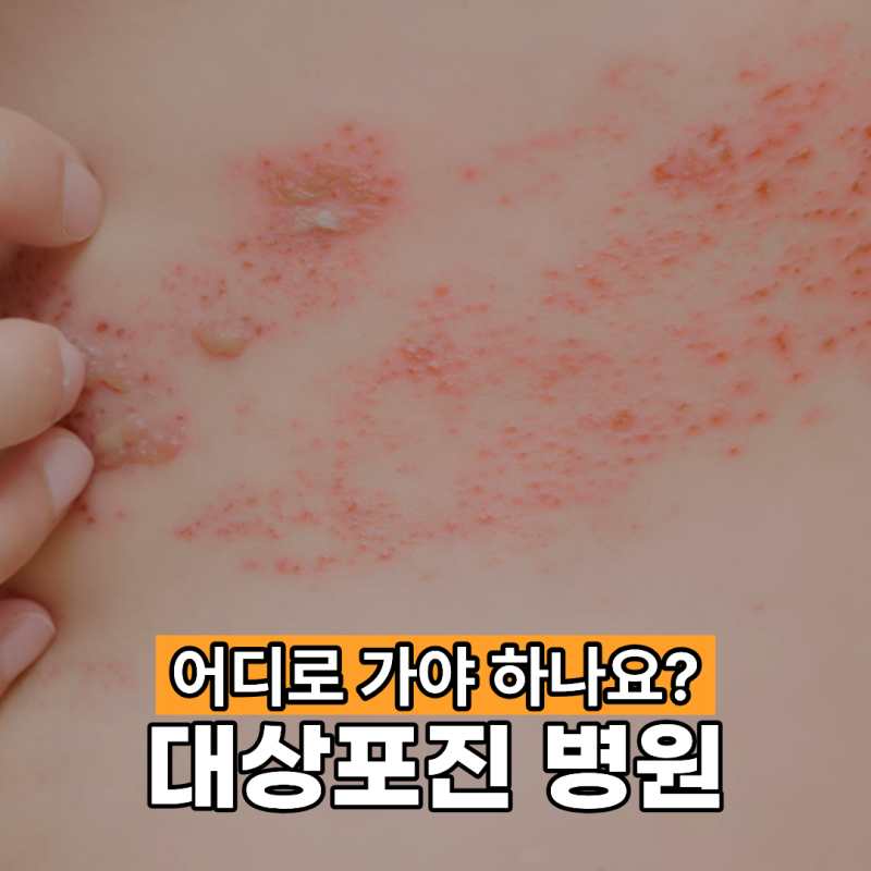 대상포진 병원 어디로 가야 하나요?