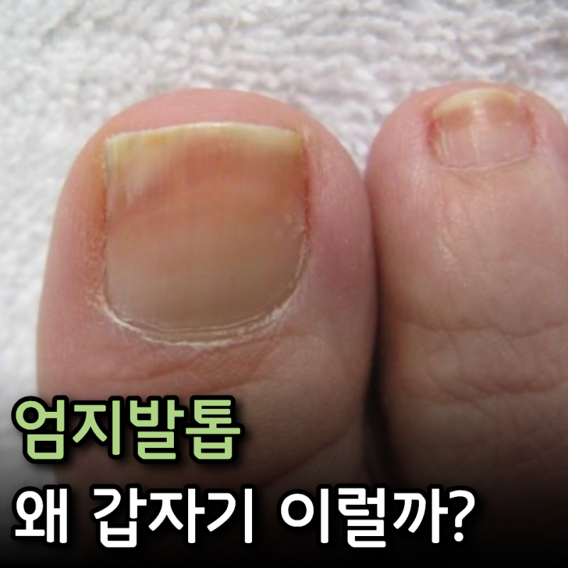 발톱 깎다가 "어라?" 멀쩡하던 엄지발톱이 두꺼워지고 들뜨는 이유