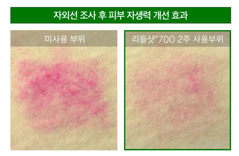 리들샷 원리 스피큘 효과 및 같이 쓰면 안되는 성분 정리