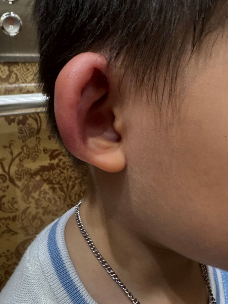 모기만 물리면 퉁퉁 붓는 아이, 모기알러지, 우리 집 상비약 챔프 알러논 알아보자!