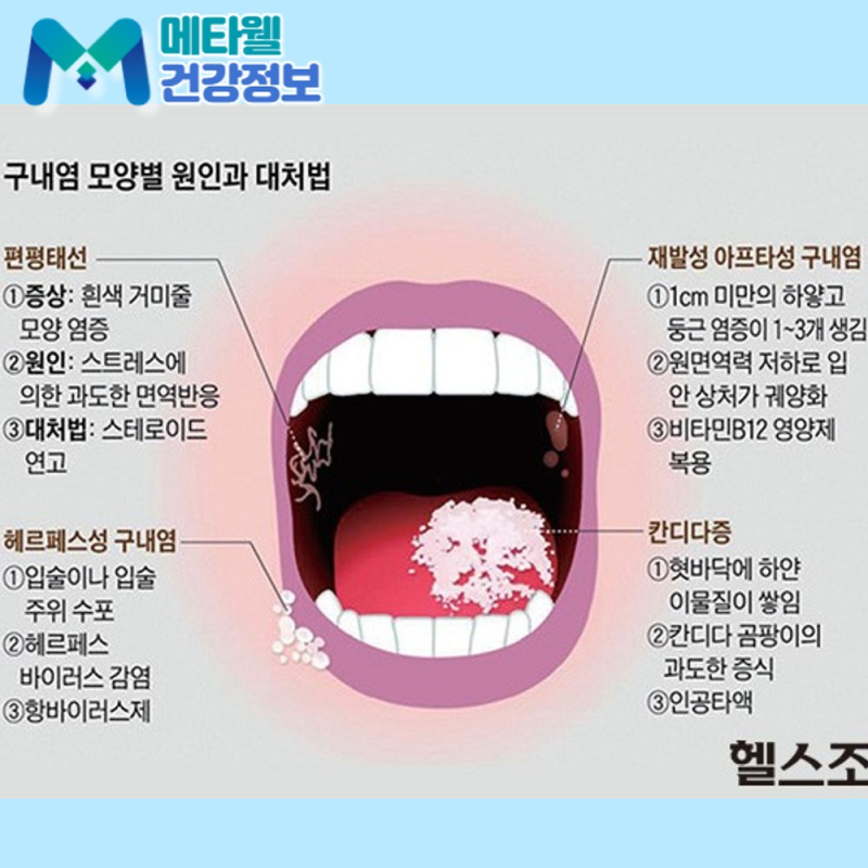 구내염약 페리덱스 사용법과 주의점, 며칠까지 발라도 될까