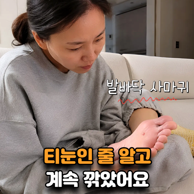 “티눈인 줄 알고 계속 깎았어요” 발바닥 사마귀 냉동치료까지 해야 할까?