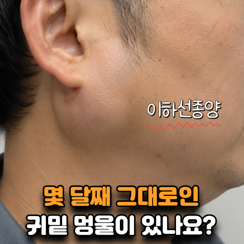 “피곤해서 임파선 부은 줄 알았어요” 몇 달째 그대로인 귀밑 멍울, 이하선종양일까?