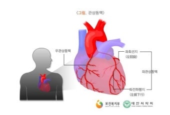 "가슴을 쥐어짜는 듯한 통증?" 방치하면 돌연사 부르는 '협심증' 원인부터 좋은 음식·예방법....
