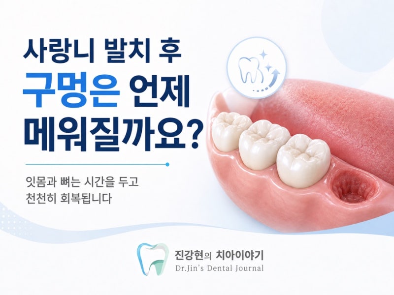 사랑니 발치 후 구멍은 언제 메워질까요?