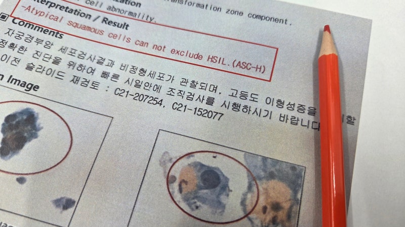 자궁경부 원추절제술 하면 이형성세포는 완벽하게 제거 될까?