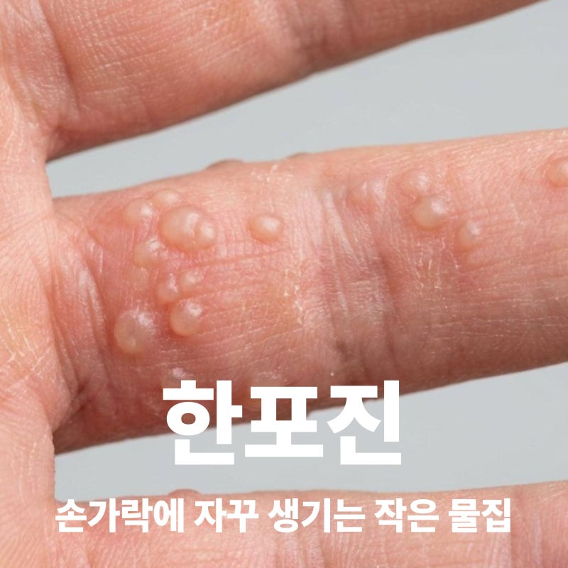 한포진 초기증상과 원인, 손가락에 작은 물집이 생긴다면