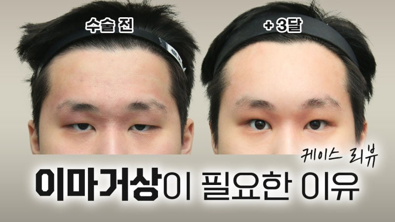 안검하수와 눈썹하수 차이, 눈매교정 효과 없었던 이유