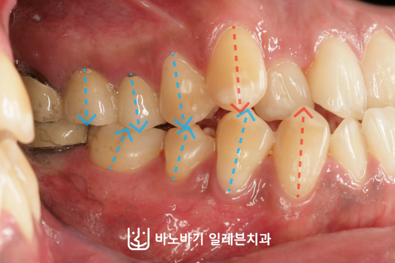 성인 3급 부정교합 원인과 유형에 따른 외모적인 단점