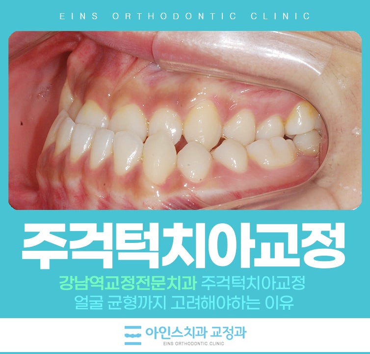 강남역교정전문치과 주걱턱치아교정 얼굴 균형까지 고려해야하는 이유