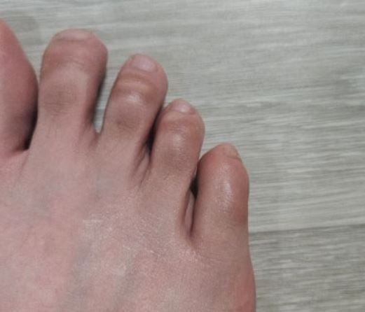 새끼발가락 굳은살이 계속 생기는 이유, 신발 문제일까 발가락 변형 때문일까?