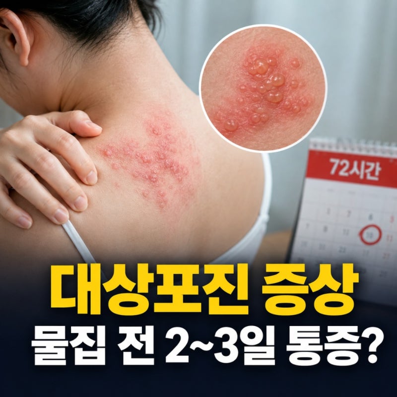 대상포진 증상, 물집 생기기 전 이미 시작된다? 놓치기 쉬운 2~3일과 치료 72시간