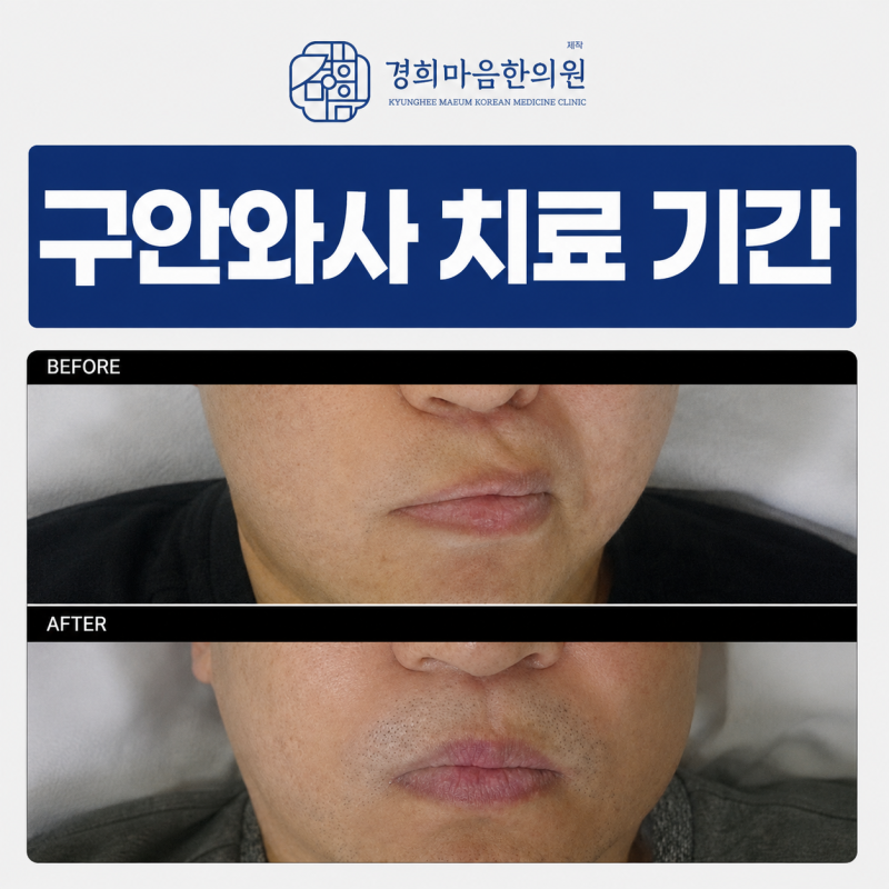 구안와사 치료 기간, 발병 7일차부터 30일차까지 회복 사례 정리
