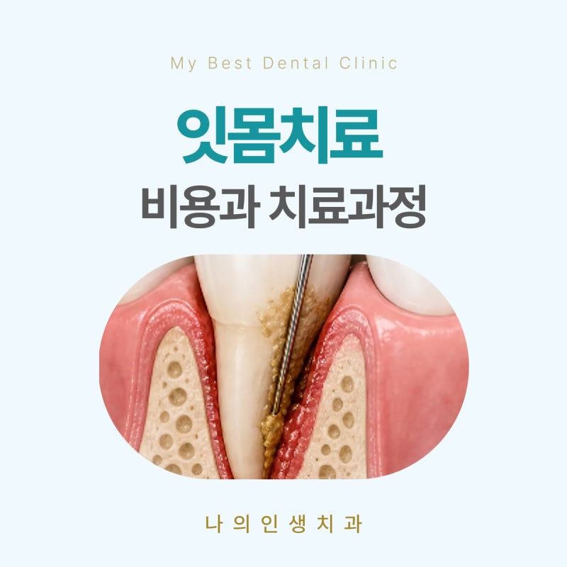평택송탄치과 잇몸치료 비용과 진행 과정, 식사는 언제부터 가능할까?