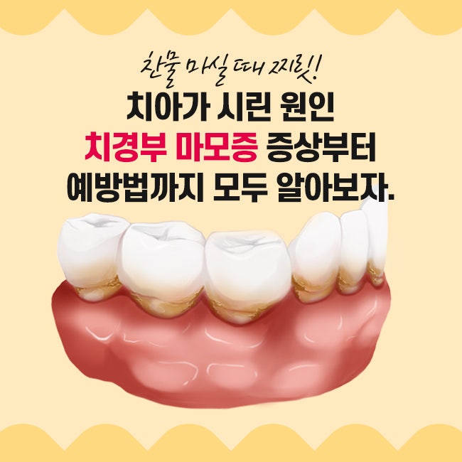 찬물 마실 때 찌릿! 치아가 시린 원인 치경부 마모증 증상부터 예방법까지 모두 알아보자.