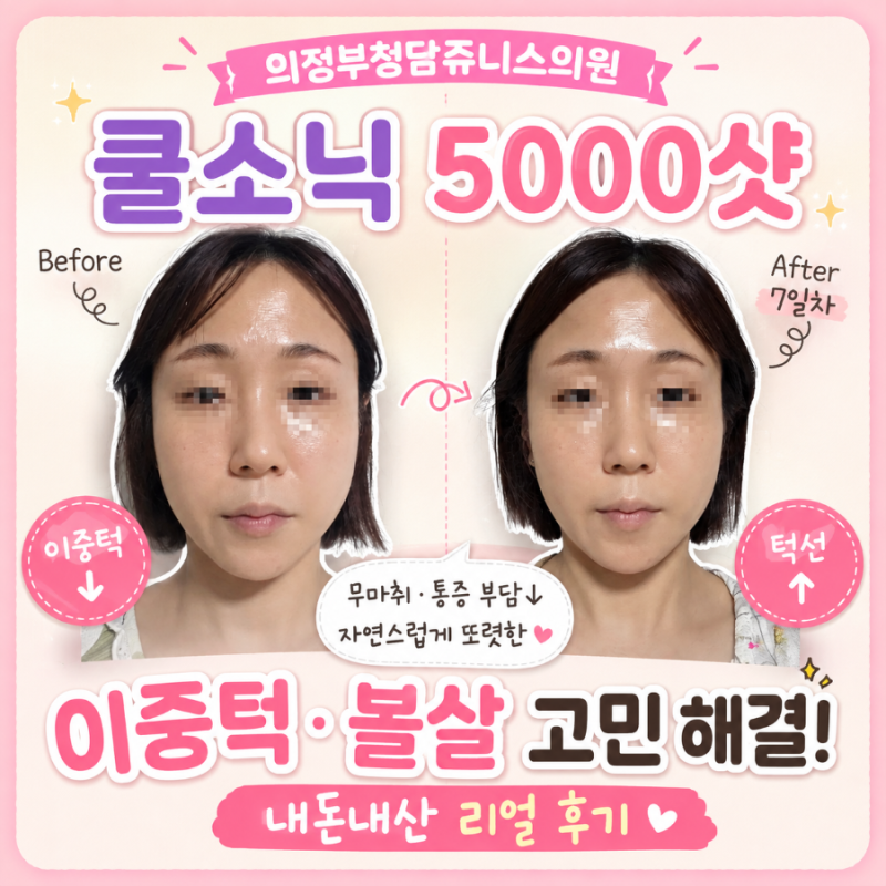 의정부청담주니스의원 쿨소닉 5000샷 통증없이 얼굴라인관리 내돈내산 후기