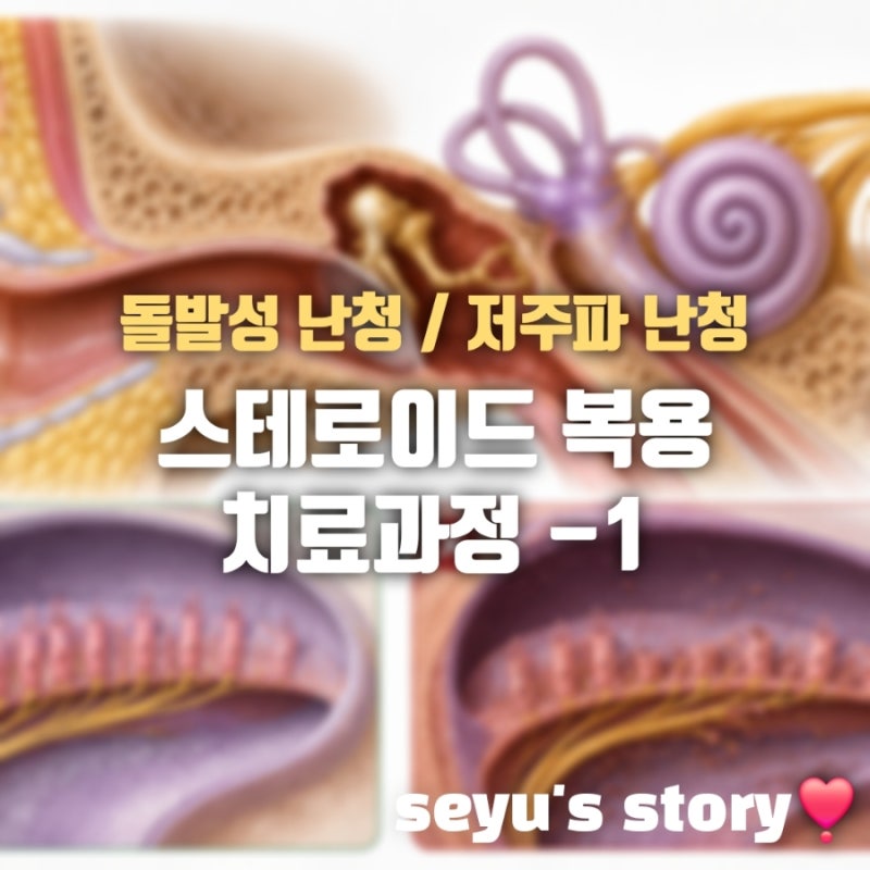 [난청일기] 돌발성 난청/저주파성 난청 스테로이드 복용 치료 과정 - 1