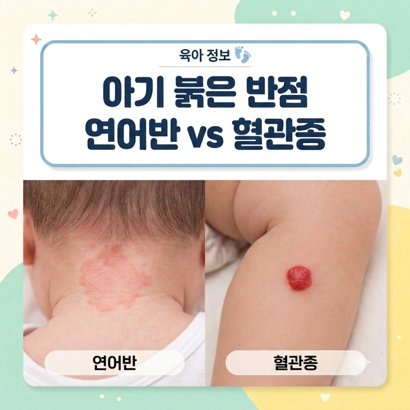 아기 얼굴 붉은자국 혈관종? 연어반? (원인, 구분법, 약물 및 레이저 치료)