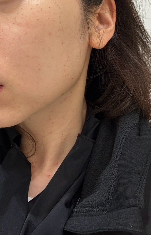 편평사마귀 500개 이상 제거 찐 후기..｜10개월 변화, 비용부터 통증, 흉터까지 솔직 후기 [내....