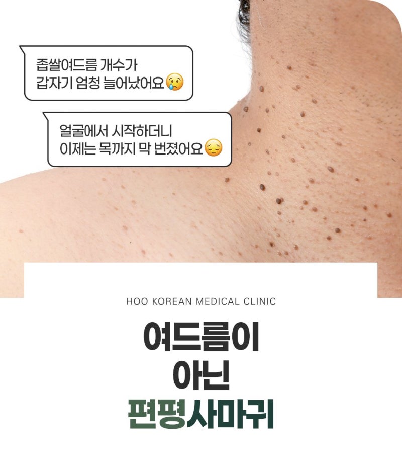 전주 편평사마귀 제거 레이저, 흉터 없이 없애려면 장비 선택이 먼저입니다
