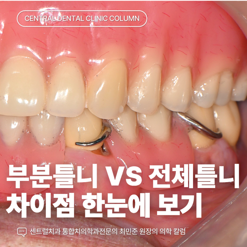 부분틀니와 전체 틀니 제작 기간과 보험 가격은 어떻게 다를까요?