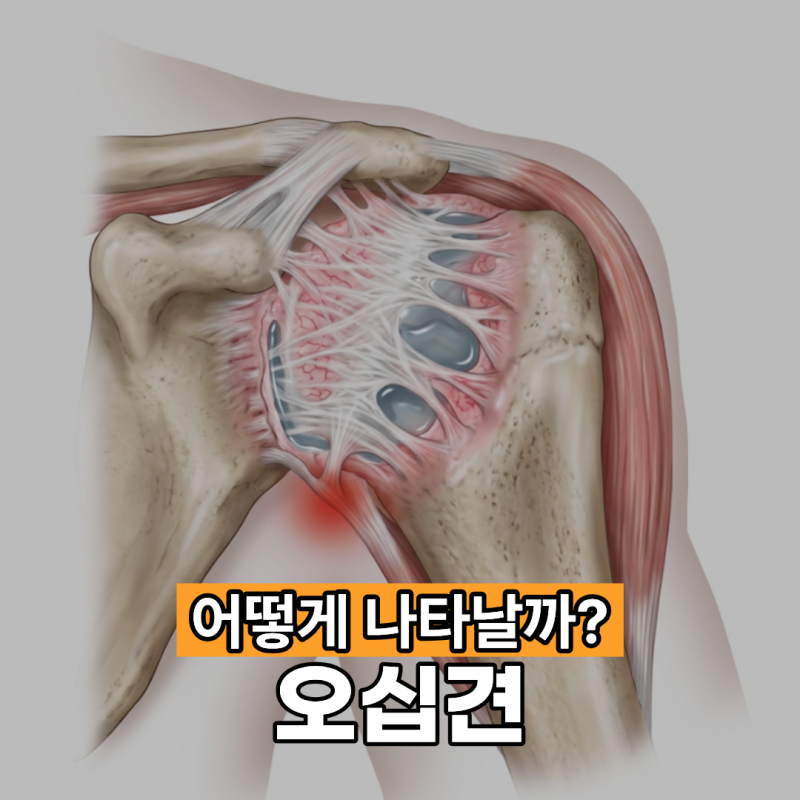 오십견 증상 어떻게 나타날까?
