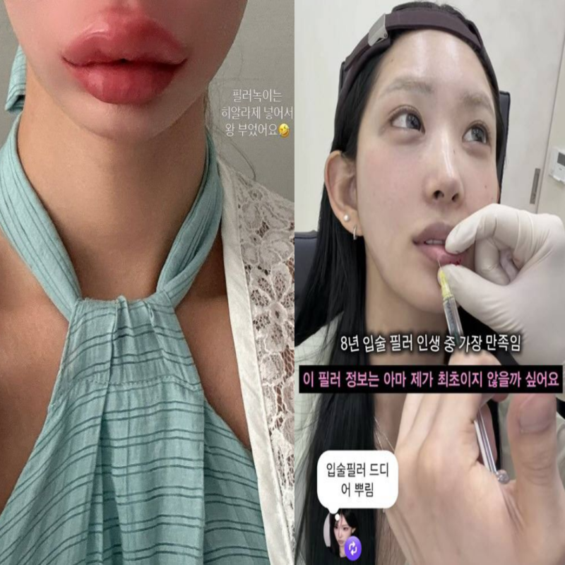 예뻐지려고 맞은 필러를 왜 다시? 의외로 많은 입술필러 녹이기 이유