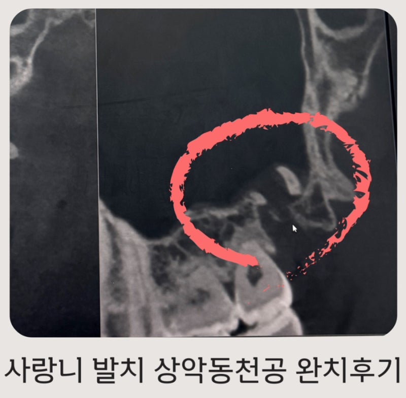 사랑니 발치 후 상악동 천공, 6주 만에 완치된 솔직 후기(수영장부터 관리 팁까지)