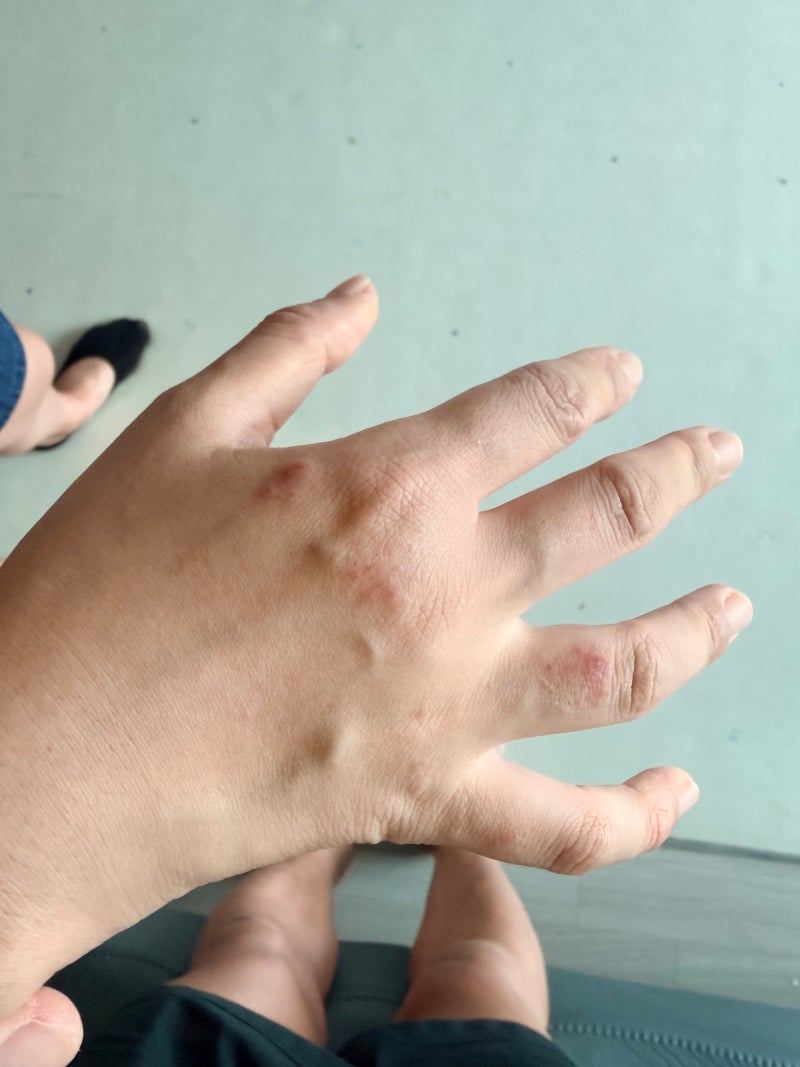 손 습진이 자꾸 재발하는 이유, 보습만으로 안 되는 경우 (손 습진 원인, 손등 피부염, 관리법....