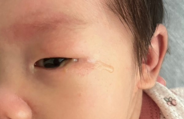 신생아 눈꼽 많이 생기는 이유 눈물샘 마사지 및 눈꼽 닦는 방법 관리팁