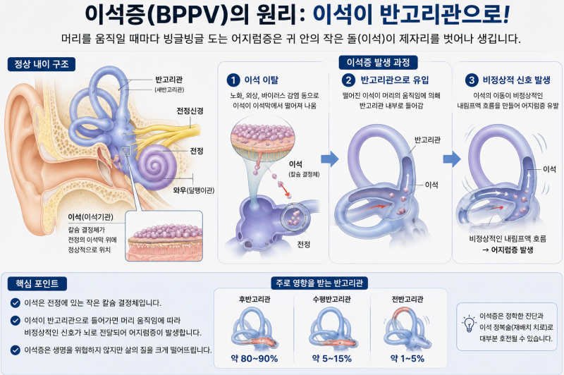 갑자기 어지럽고 빙글빙글 도는 이석증 | 원인 및 증상 차이·이석치환술(에플리법)·응급 대....