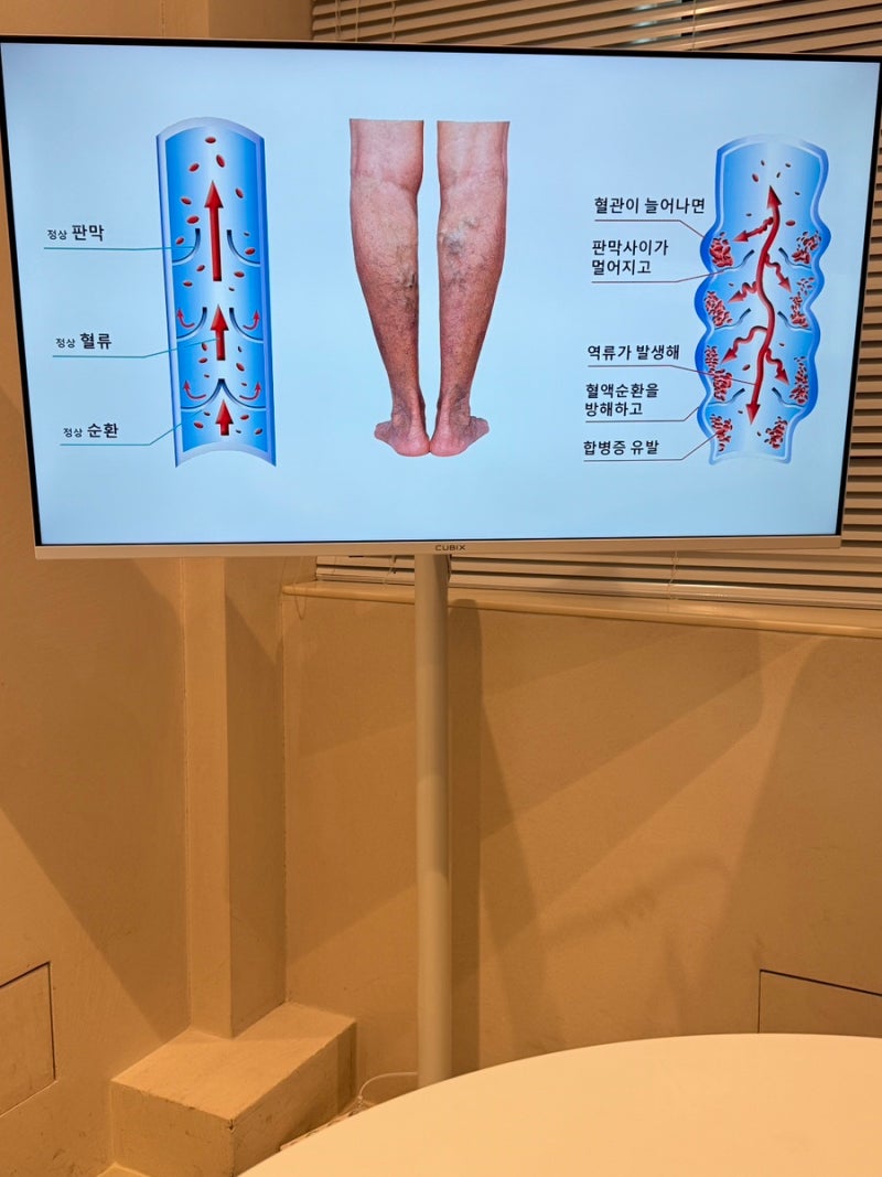 압구정 바리톤 다리 혈관 제거 레이저 후기, 다리실핏줄 치료 받아본 후기