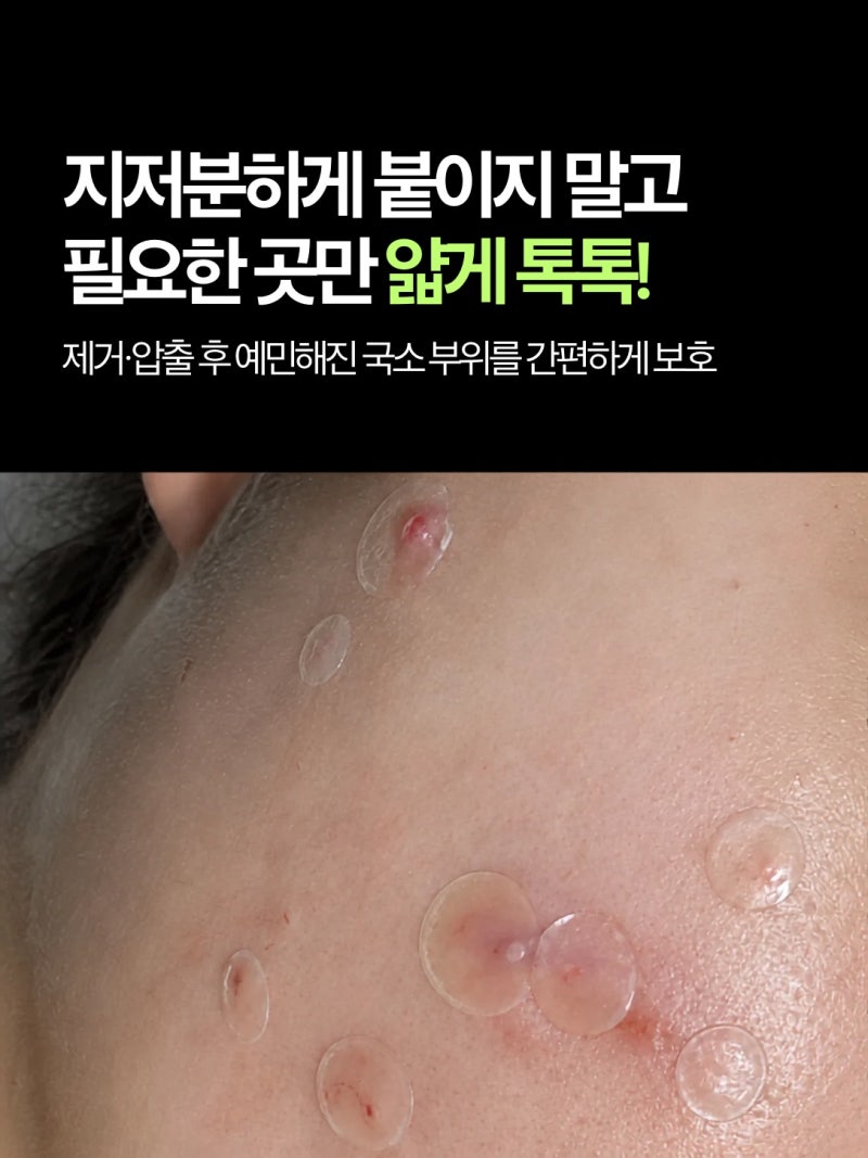 여드름 압출 후 패치 계속 붙이세요?
