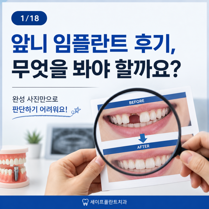 앞니 임플란트 후기 살펴보는 요령과 비용, 기간 정보