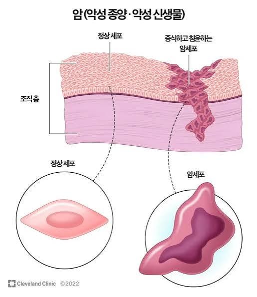 완치 판정 가능성 높은 암 순위