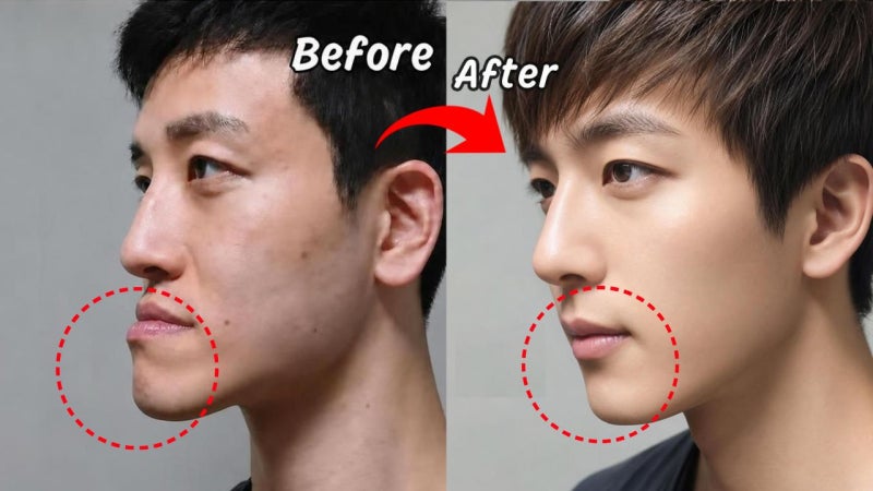 성인 주걱턱 교정, 수술 없이 가능할까?