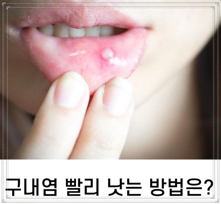 구내염 왜 자꾸 생길까? 입안 헐었을때 원인과 증상, 빨리 낫는법