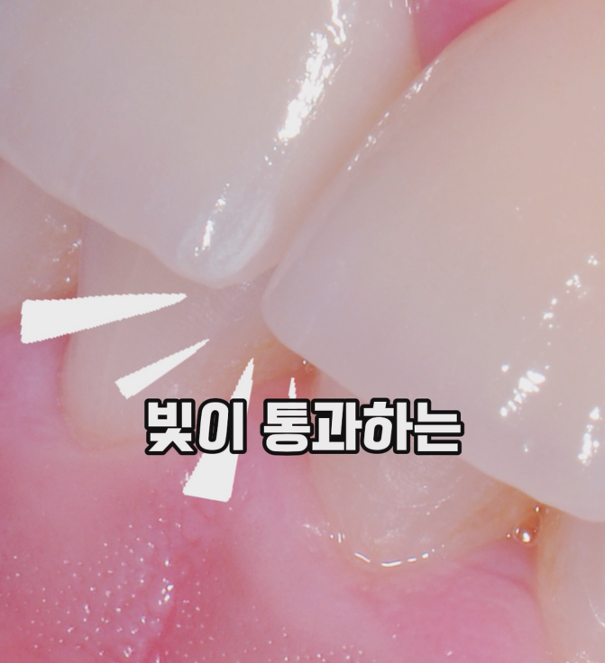 앞니 크라운 교체 가격 절감법! 비용 낭비 줄이는 3가지 조건