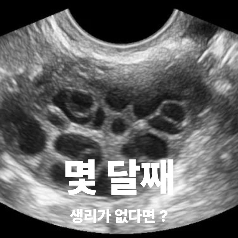 다낭성난소증후군이란? 증상과 원인, 생리가 불규칙하다면