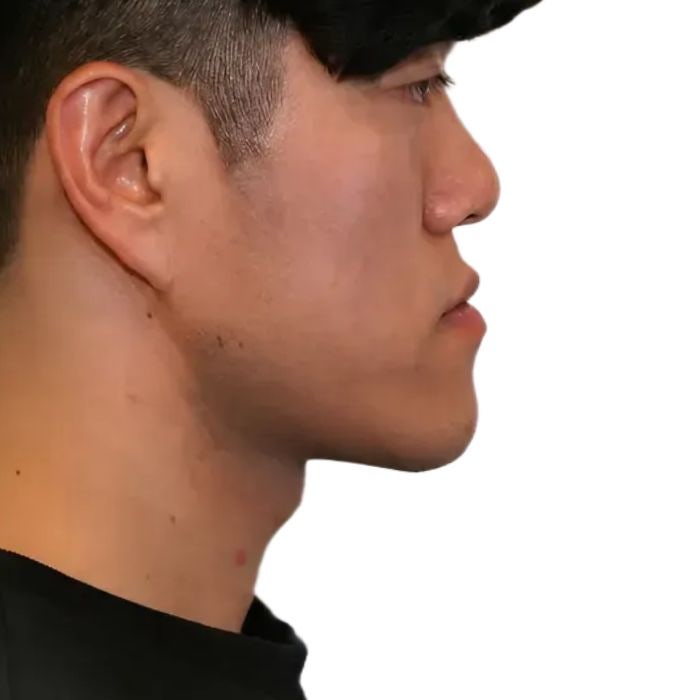"수술하세요" 들었는데, 비수술 교정으로 해결된 주걱턱 실제 후기