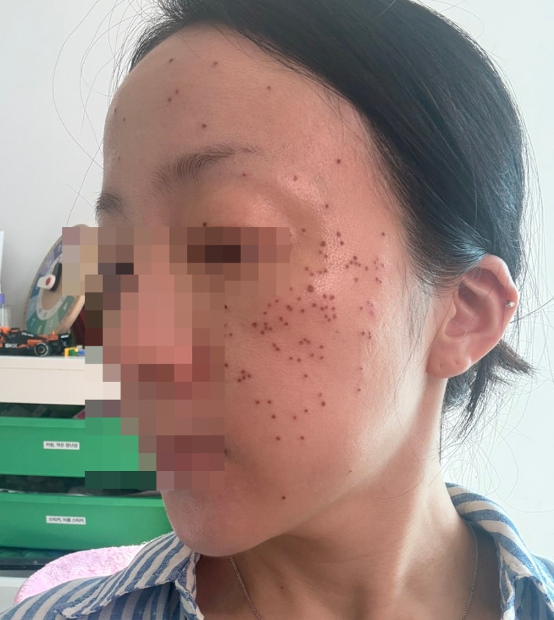 비립종 제거 비용, 기미 잡티 200개 뺀 후기