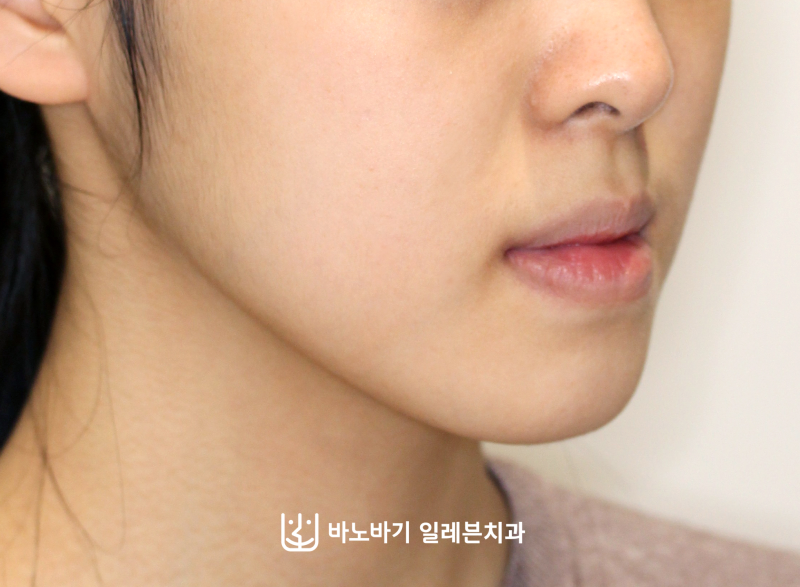 비수술 주걱턱 교정, 프랑켈교정을 받은 10대 여자 중학생 재교정 진료 후기