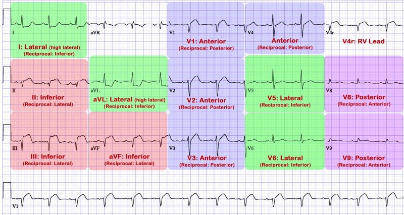 Cath lab의 ECG, EKG 심전도 정복하기! 마지막장