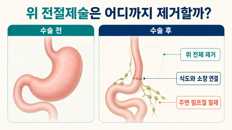 위 전절제했는데도 위암 4기가 될 수 있을까? 수술 후 재발·전이 확인할 5가지